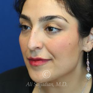 before rhinoplasty left angle view female patient case 20777