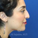before rhinoplasty right side view female patient case 20777
