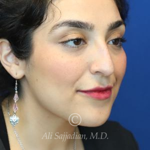 before rhinoplasty right angle view female patient case 20777