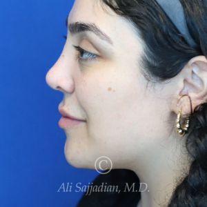 after rhinoplasty left side view female patient case 20777