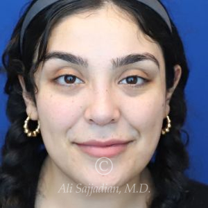 after rhinoplasty front view female patient case 20777