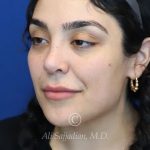after rhinoplasty left angle view female patient case 20777