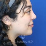 after rhinoplasty right side view female patient case 20777