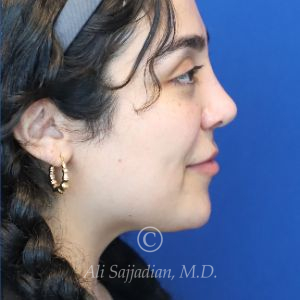 after rhinoplasty right side view female patient case 20777