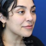 after rhinoplasty right angle view female patient case 20777
