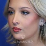 after rhinoplasty left angle view female patient case 20788