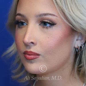 after rhinoplasty left angle view female patient case 20788