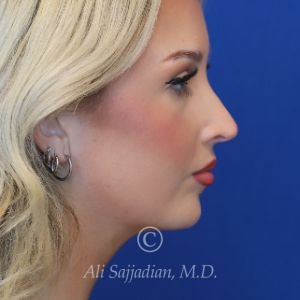 after rhinoplasty right side view female patient case 20788