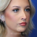 after rhinoplasty right angle view female patient case 20788
