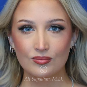 after rhinoplasty front view female patient case 20788