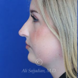 before rhinoplasty left side view female patient case 20788