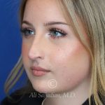 before rhinoplasty left angle view female patient case 20788