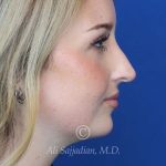 before rhinoplasty right side view female patient case 20788