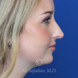 before rhinoplasty right side view female patient case 20788