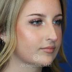 before rhinoplasty right angle view female patient case 20788