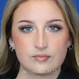 before rhinoplasty front view female patient case 20788