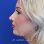 after rhinoplasty left side view female patient case 20788