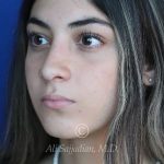 after rhinoplasty left angle view of female patient 21484