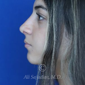 after rhinoplasty left side view of female patient 21484