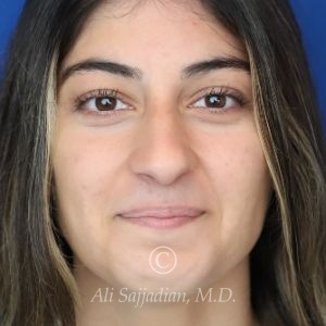 after rhinoplasty front view of female patient 21484