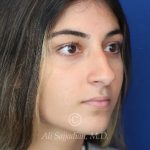 before rhinoplasty right angle view of female patient 21484