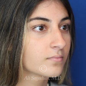 before rhinoplasty right angle view of female patient 21484