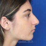 before rhinoplasty right side view of female patient 21484