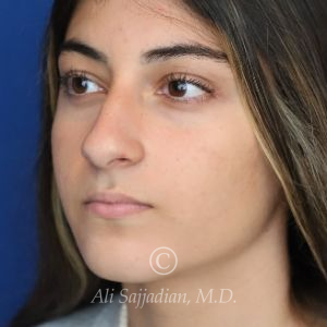 after rhinoplasty left angle view of female patient 21484