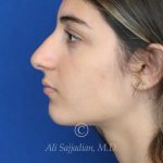 before rhinoplasty left side view of female patient 21484
