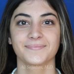 before rhinoplasty front view of female patient 21484
