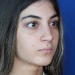 before rhinoplasty right angle view of female patient 21484