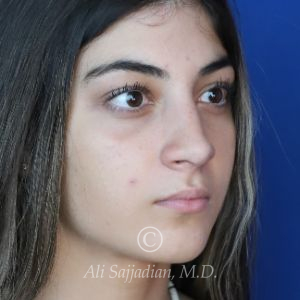 before rhinoplasty right angle view of female patient 21484