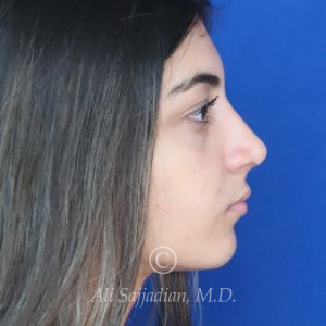 after rhinoplasty right side view of female patient 21484