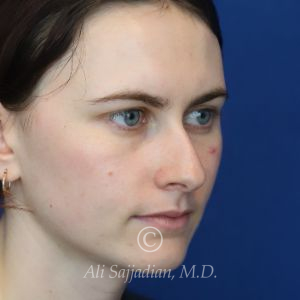 before rhinoplasty right angle view of female patient 21507