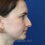 before rhinoplasty right side view of female patient 21507