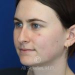 before rhinoplasty right angle view of female patient 21507
