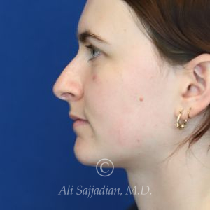 before rhinoplasty left side view of female patient 21507