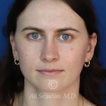 after rhinoplasty front view of female patient 21507