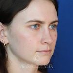 after rhinoplasty right angle view of female patient 21507