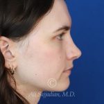 after rhinoplasty right side view of female patient 21507