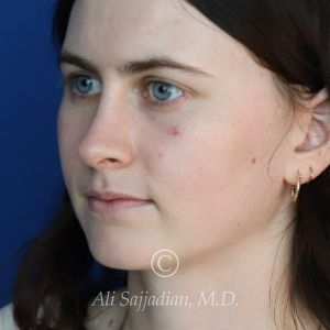 after rhinoplasty left angle view of female patient 21507