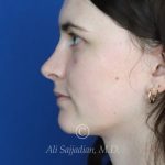 after rhinoplasty left side view of female patient 21507