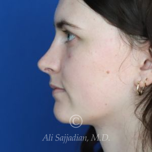 after rhinoplasty left side view of female patient 21507