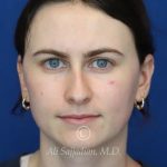before rhinoplasty front view of female patient 21507