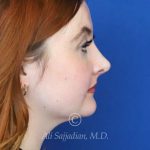 after rhinoplasty right side view of female patient 21519