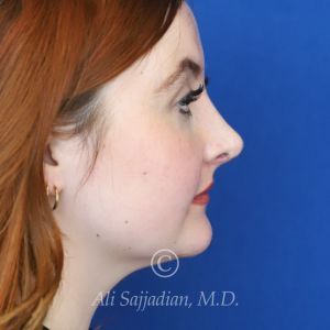 after rhinoplasty right side view of female patient 21519