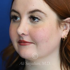 after rhinoplasty left angle view of female patient 21519