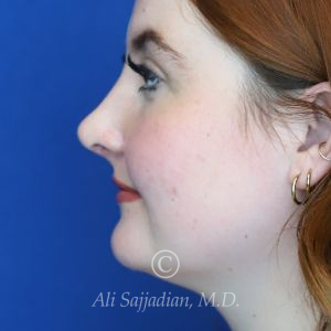 after rhinoplasty left side view of female patient 21519