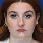 before rhinoplasty front view of female patient 21519