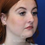 before rhinoplasty right angle view of female patient 21519